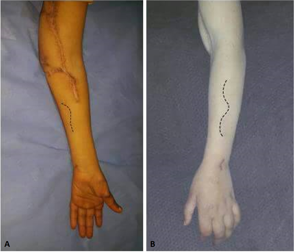 Innovative Management Strategy for Combined Proximal Median and Ulnar Nerve Extensive Injury: A Case Report