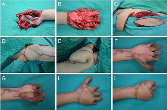 Sandwich Flap Reconstruction for a Degloving Hand Injury