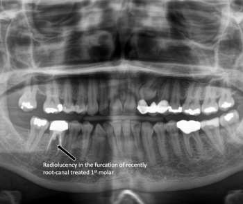 Looking Beyond the Obvious! A Case of Sialolithiasis Masquerading as an Odontogenic Abscess