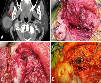Challenges Associated With Aberrant Facial Nerve Anatomy in Parotidectomy: A Case Report