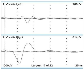 New Insights Into Reinnervation of the Vocalis Muscles After Recurrent Laryngeal Nerve Repair: Electrophysiological Evidence