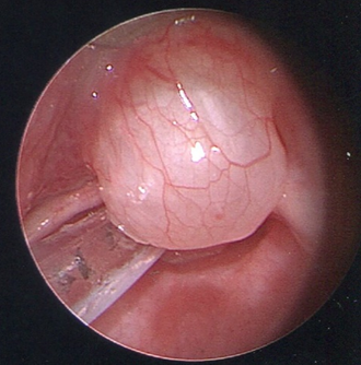 Airway Obstruction Management in an Infant With a Large Vallecular Cyst: Awake Fiberoptic Intubation and Transoral CO2 Laser Microsurgery for Effective Resection