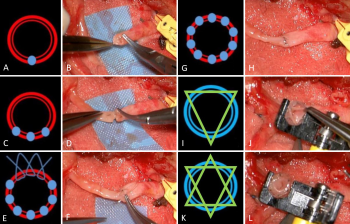 Techniques Useful in Complex Microvascular Anastomosis