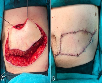 Clinical Applications of Keystone Design Perforator Island Flap: A Single-Center Experience