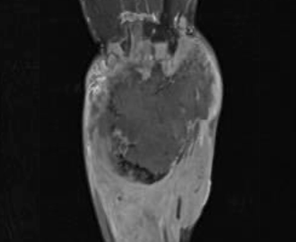 Upper Extremity Reconstruction Post-Tumor Resection: Innovations and Challenges in Limb Preservation for Advanced-Stage Malignant Giant Cell Tumor of Bone