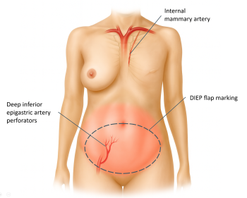 Reconstruction of Massive Chest Wall Defect After Bilateral Mastectomy Using a Bipedicled Deep Inferior Epigastric Perforator Flap: A Case Report