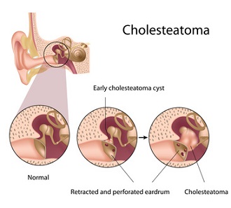 Relationship between Depression and Cholesteatoma