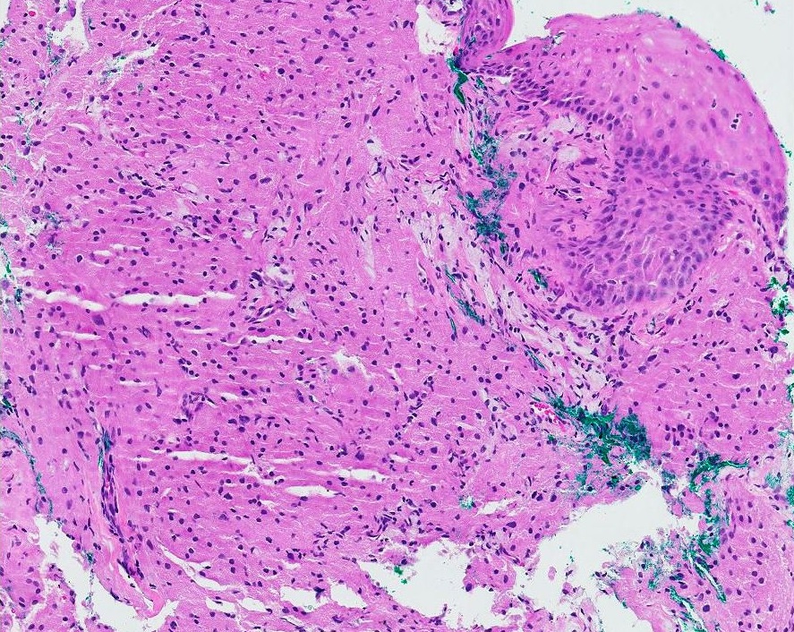 Granular Cell Tumor of Esophagus: A Rare Disease of the Esophagus