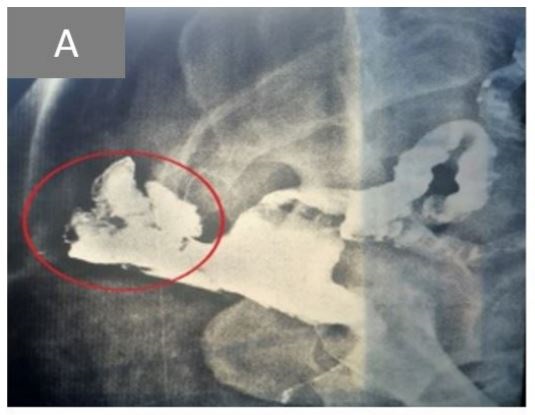 Management of Post-Traumatic Posterior Rectal Pouch Through a Posterior Approach