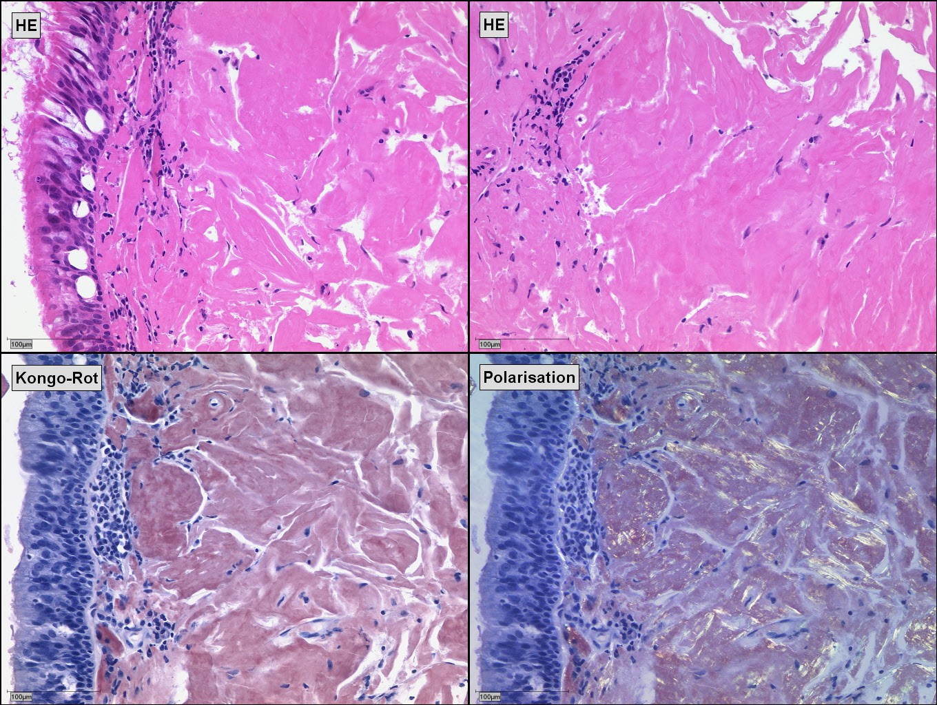 Eustachian Tube Dysfunction in Patients with Localized Amyloidosis of the Nasopharynx and Eustachian Tube