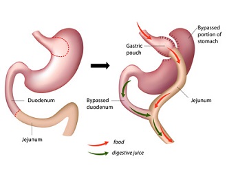 Recalcitrant Hypocalcemia in Roux-en-Y Gastric Bypass Patients After Parathyroidectomy: Successful Management With Gastrostomy Tube Placement