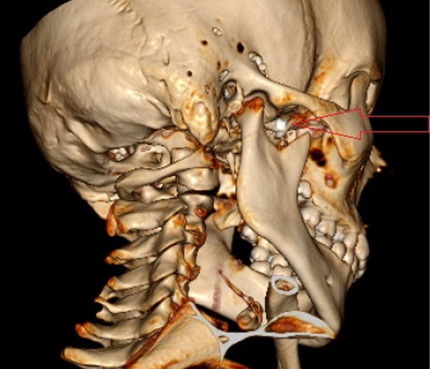 An Unusual Foreign Body Within the Pterygopalatine Fossa: A Case Report