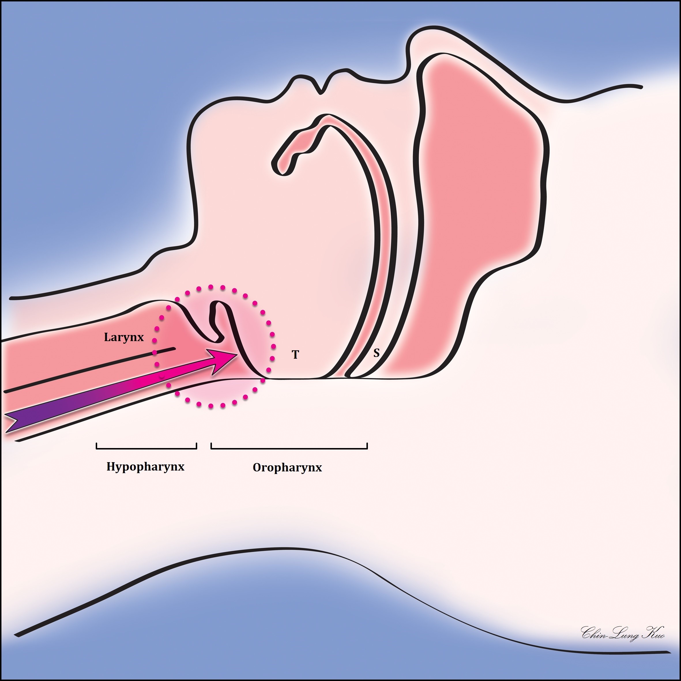 Acid Reflux Increases Susceptibility to Laryngopharyngeal and Oropharyngeal Cancers