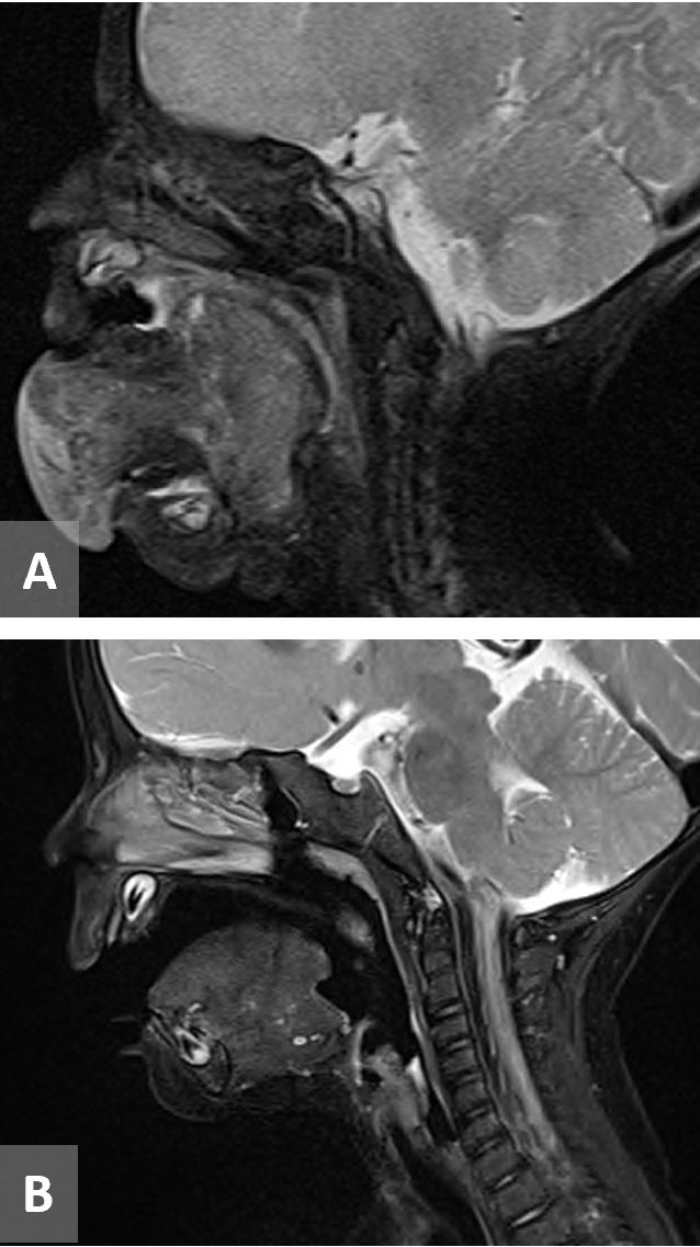 ALK+ Inflammatory Myofibroblastic Tumor of the Tongue in a Neonate Treated With Crizotinib