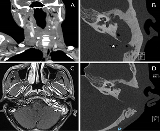 Otogenic Lemierre’s Syndrome With Bilateral Metastatic Pneumonia: Report of an Unusual Case in a Male