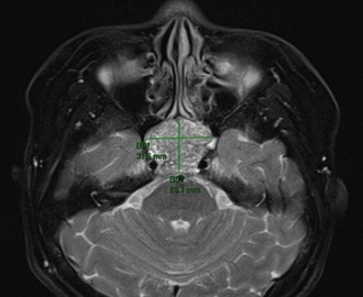 Managing a Complex Pituitary Tumor: A Case Study on Effective Diagnosis and Treatment of a Challenging Clival Lesion