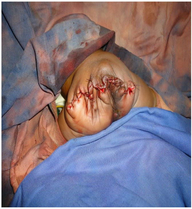 Giant Sacrococcygeal Teratoma in Newborns: Management of Two Cases in an Underdeveloped Country