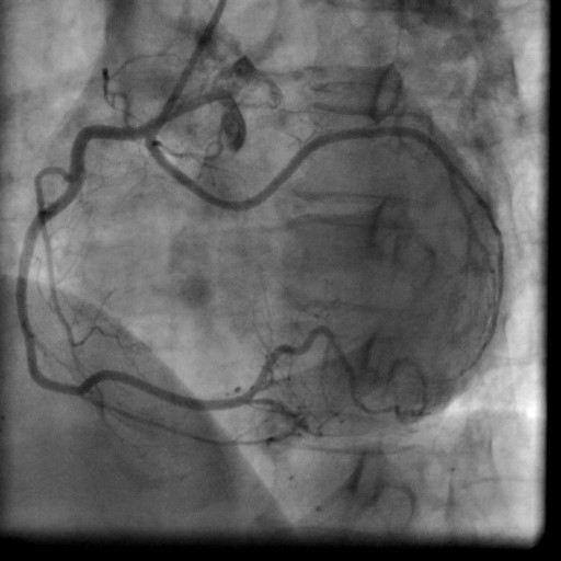 Twin Circumflex Arteries: A Rare Coronary Artery Anomaly