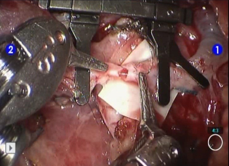 Experience with robotic-assisted microsurgery