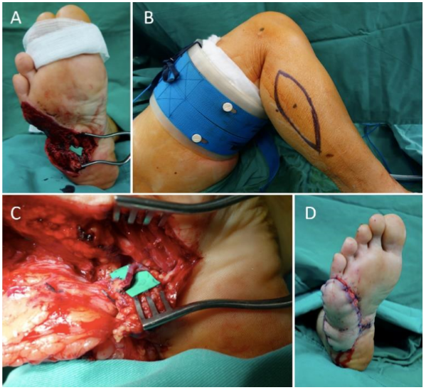 The Lateral Plantar Artery as Recipient Vessel for Microsurgical Lateral Plantar Forefoot Reconstruction: Case Report