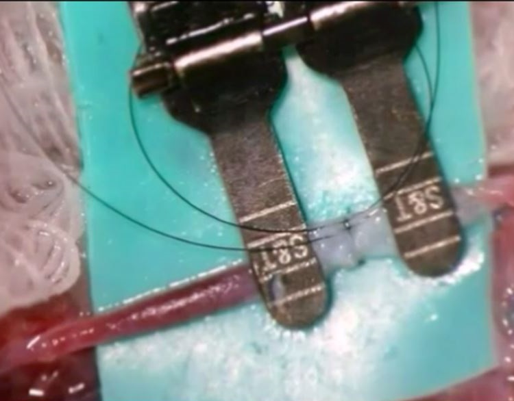 Improving Microvascular Anastomosis Efficiency by Combining Open-Loop and Airborne Suture Techniques