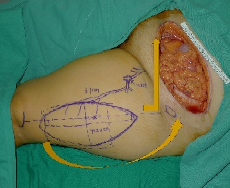 Pedicled Anterolateral Thigh Flap for Abdominal Reconstruction Following Surgical Resection of Gynecological Abdominal Wall Malignancy