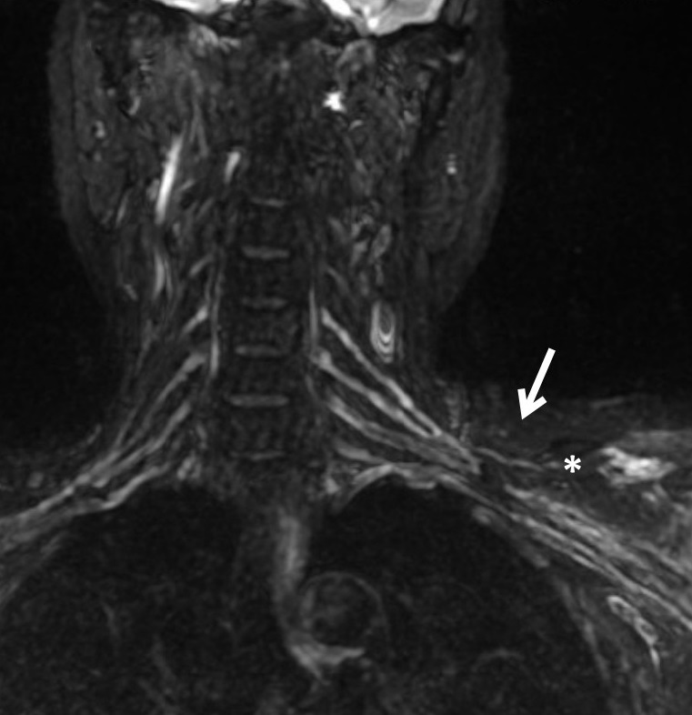 Role of Magnetic Resonance Imaging in Localization of Acute Brachial Plexus Injury