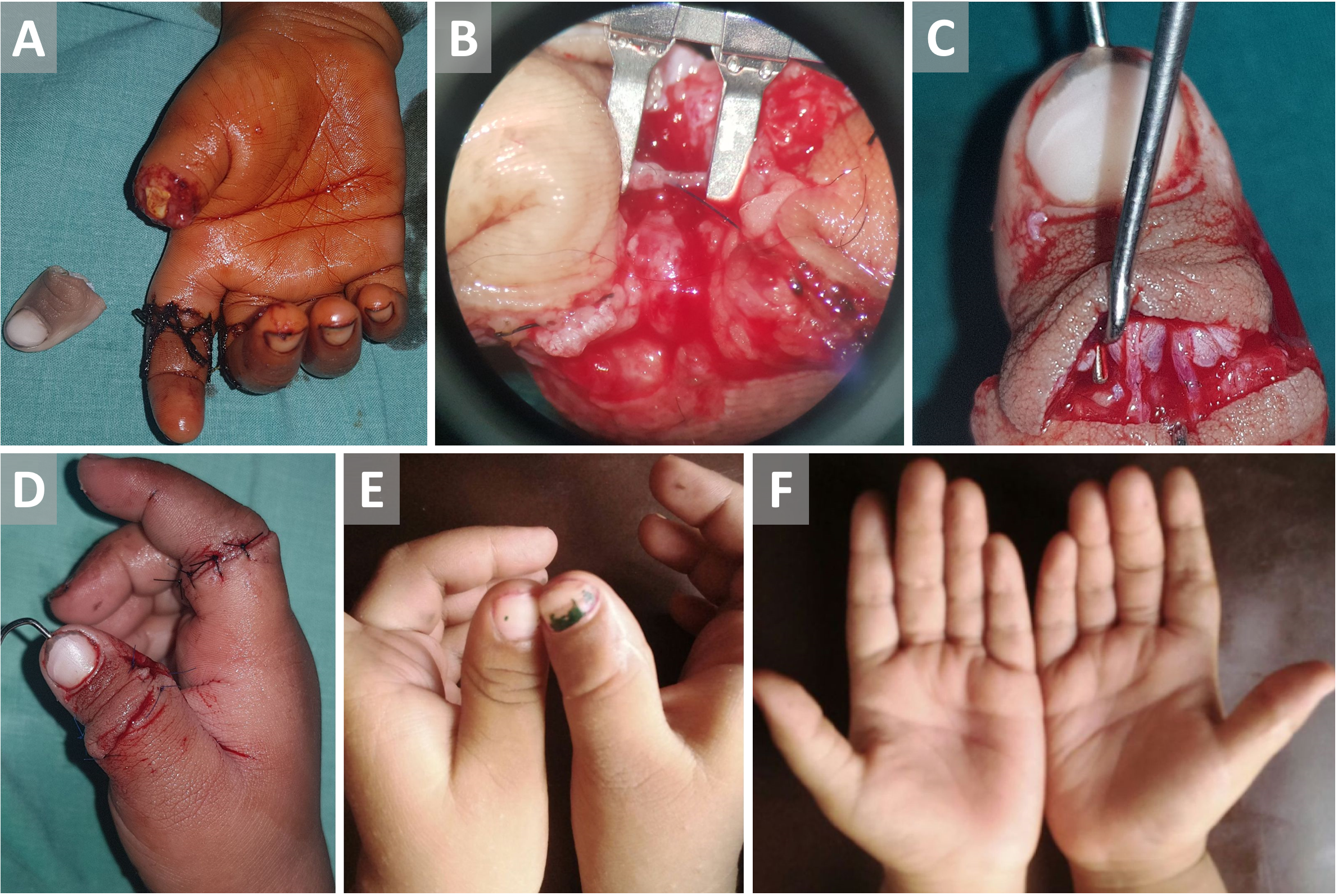 Hemi-Intravascular Stenting Technique for Super Microsurgical Anastomosis in Pediatric Thumb Replantation