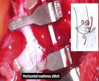 A Simplified Technique for Large Vessel Size Discrepancies: Partial Lumen-Obliteration With Sutures Followed by End-To-End Anastomosis