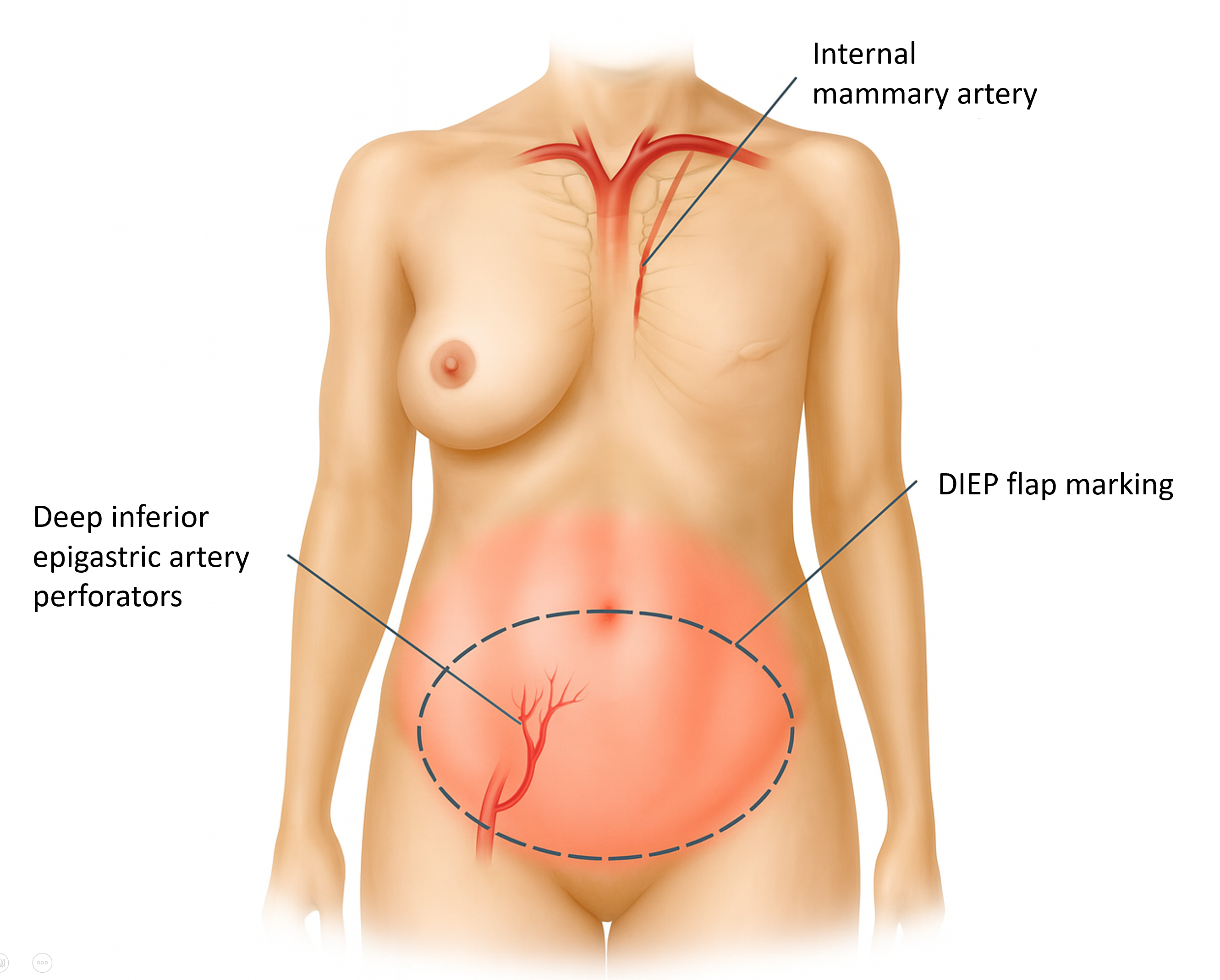 Reconstruction of Massive Chest Wall Defect After Bilateral Mastectomy Using a Bipedicled Deep Inferior Epigastric Perforator Flap: A Case Report