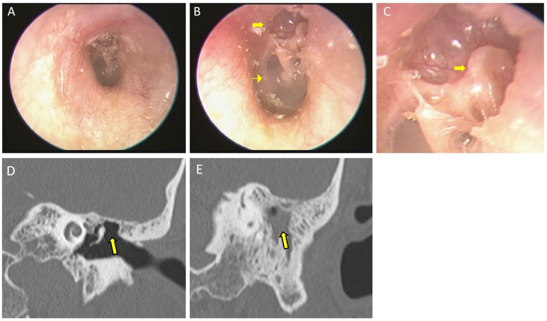 Shah Grommet Extracted From Ear Canal And Deep Retraction Pocket