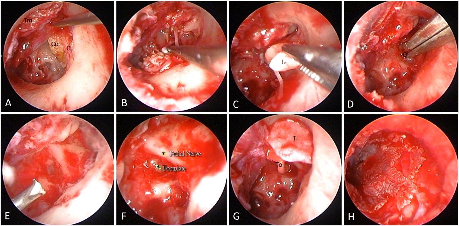 tympanic membrane cholesteatoma