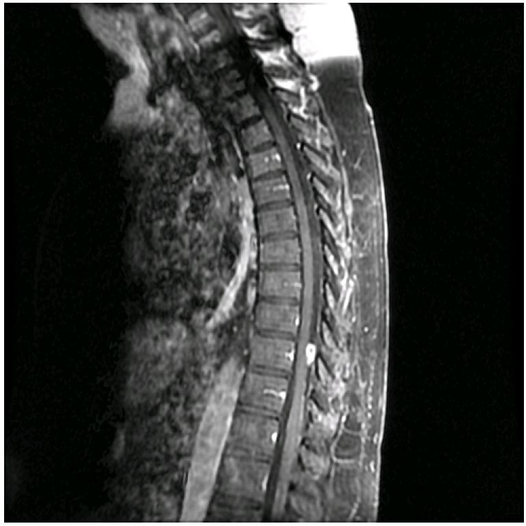 normal thoracic spine mri
