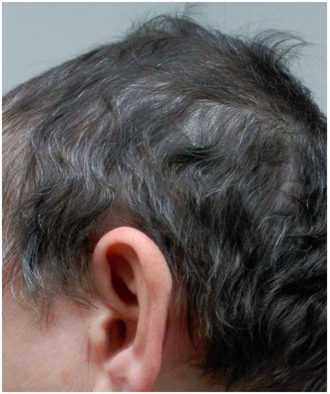 clobetasol propionate for hair loss
