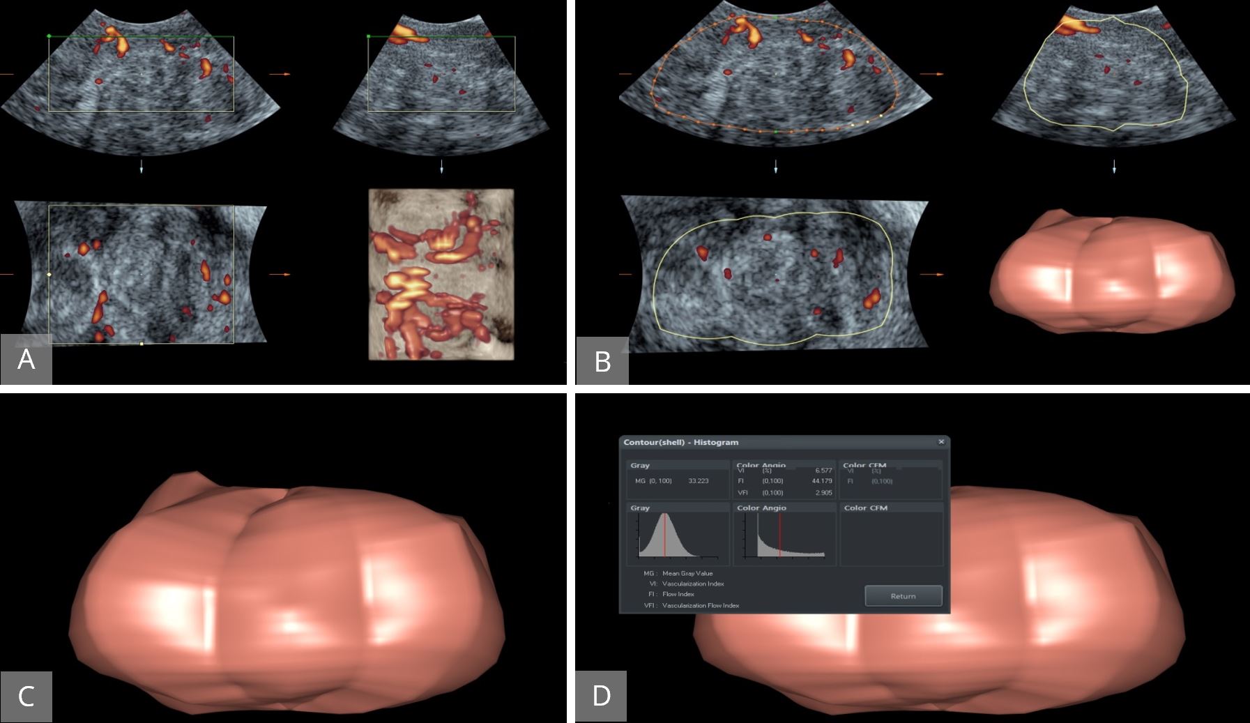 The Role Of Three Dimensional Ultrasound In Gynecology Scitemed