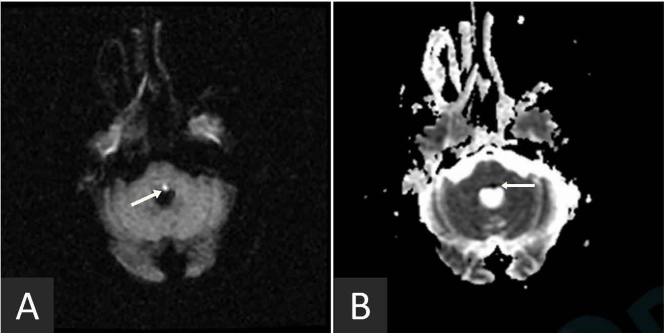 Eight-and-a-Half Syndrome Presented with Trigeminal Neuralgia - SciTeMed  Publishing Group, image size:1316x658