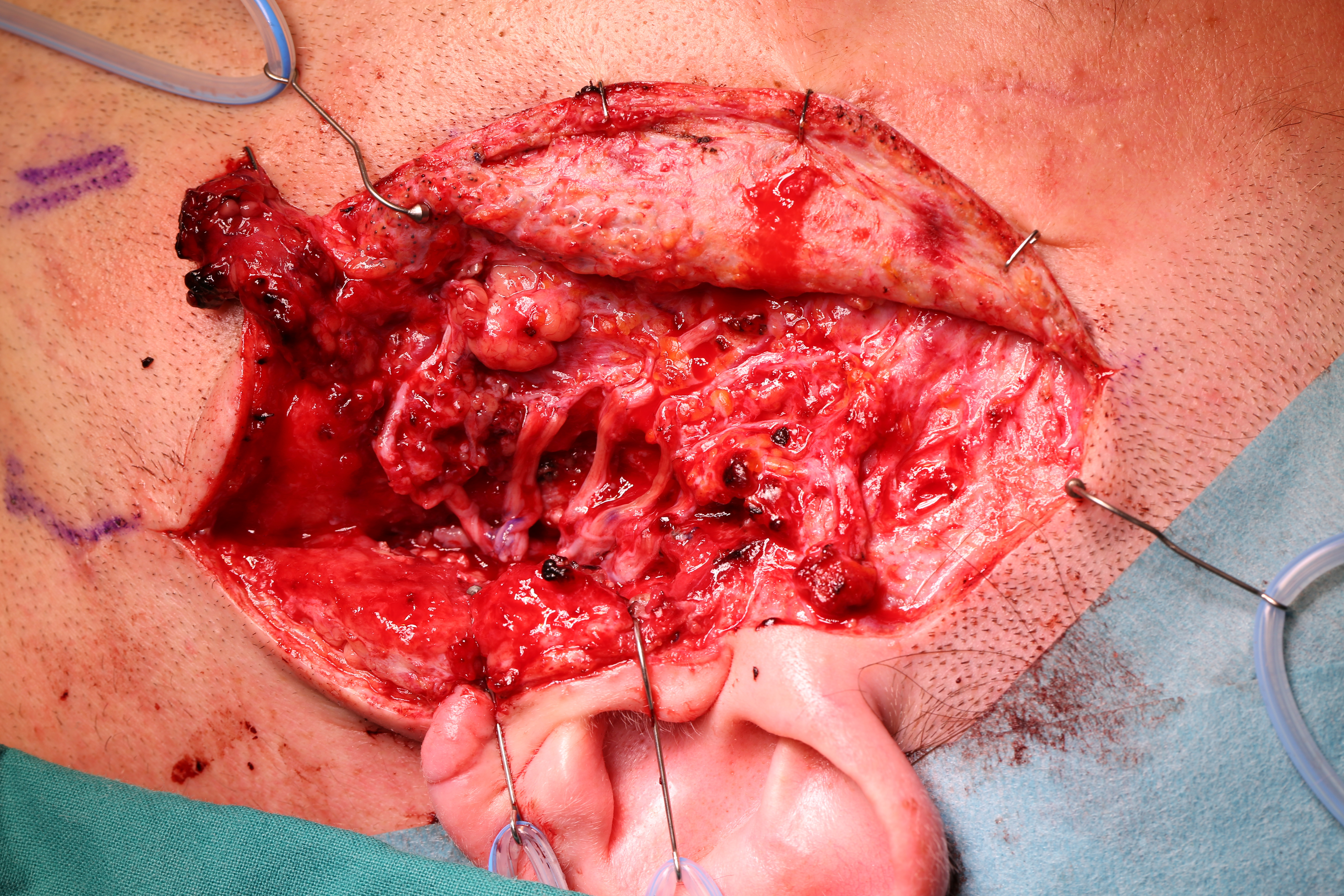Topographic Facial Nerve Transplantation - SciTeMed Publishing Group, image size:5760x3840