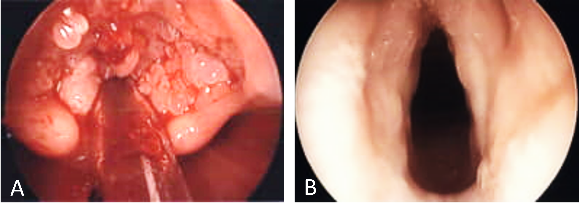 Inverted papilloma of larynx Laryngeal inverted papilloma