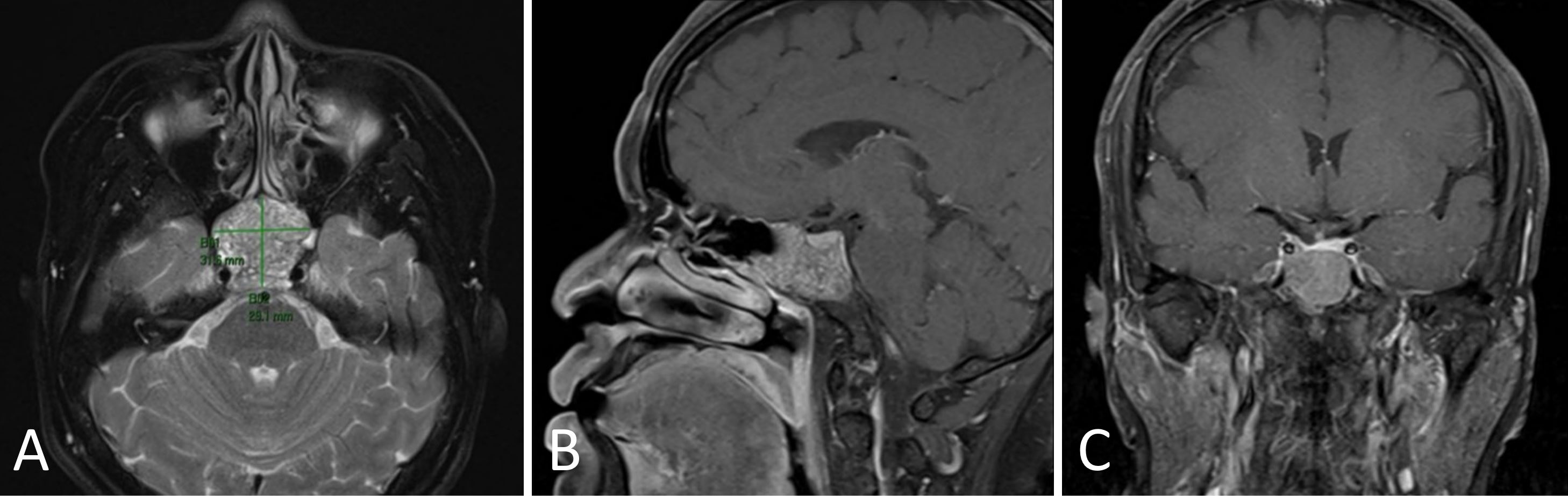 Managing a Complex Pituitary Tumor A Case Study on Effective ...